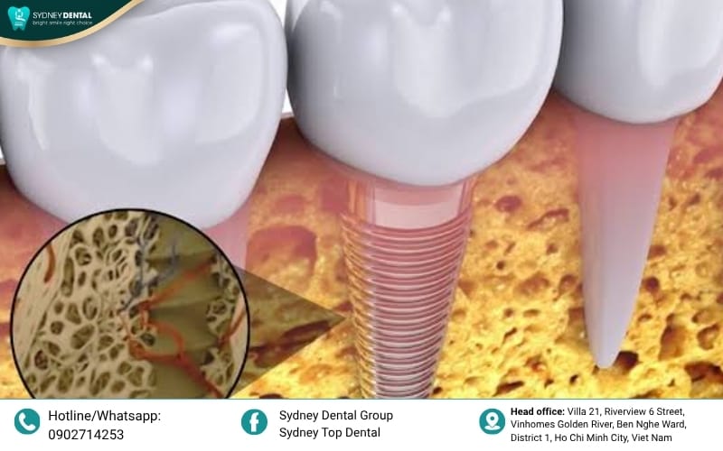 Superior mobility and comfort through direct skeletal integration.