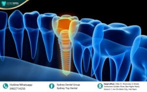Osseointegration: The Breakthrough in Functional Restoration