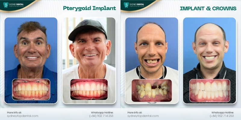 Dental implants with rapid same-day immediate loading techniques.