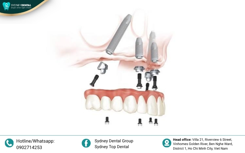 Nobel Biocare implant components featuring TiUnite surface technology, ideal for All-on-4 full-arch immediate restorations.