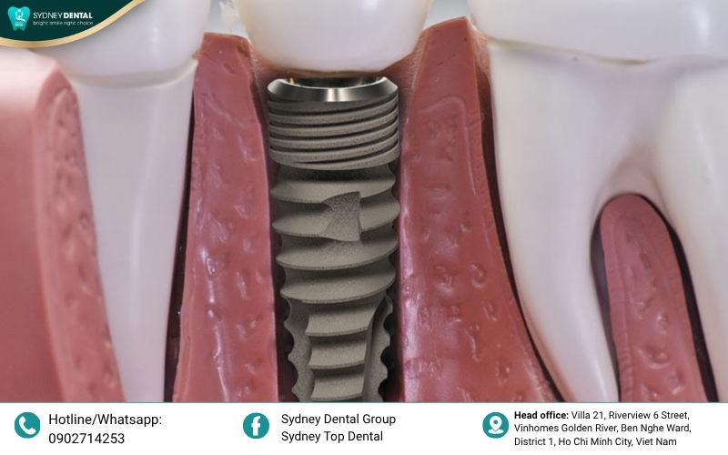 Straumann dental implants with SLActive surface technology, engineered for ultra-fast healing and superior primary stability.