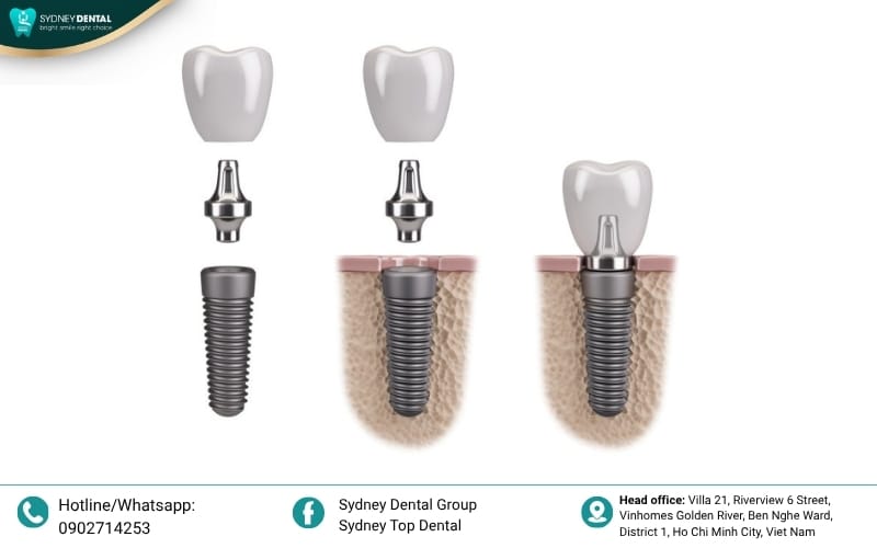 Titanium implants: The gold standard for tooth replacement