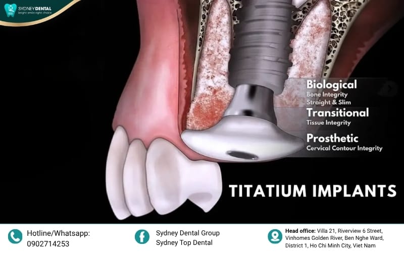 Restoring your quality of life with titanium implants.